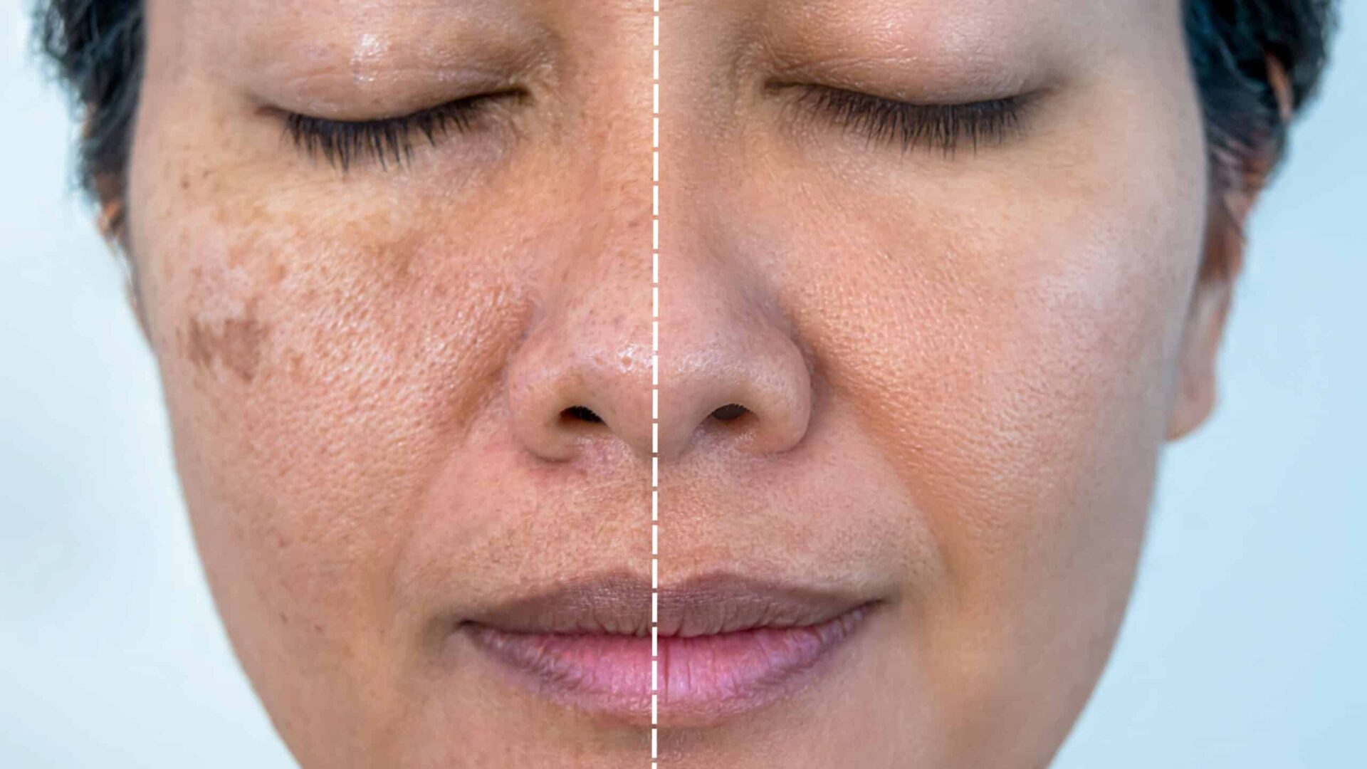 Before and after chemical peel treatment for skin rejuvenation