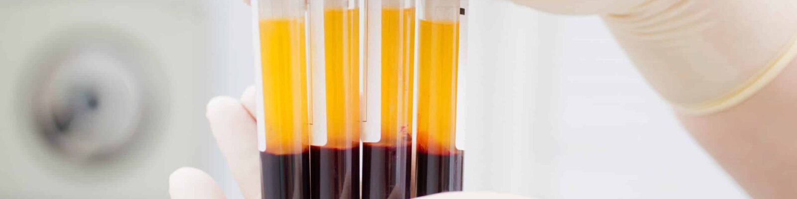 Overview of Platelet-Rich Plasma Close-up of hands holding vials of platelet-rich plasma in a medical setting