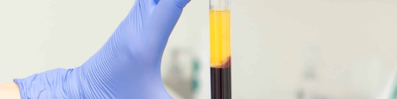 prp-injections Gloved hand holding a vial of platelet-rich plasma for skin treatment.